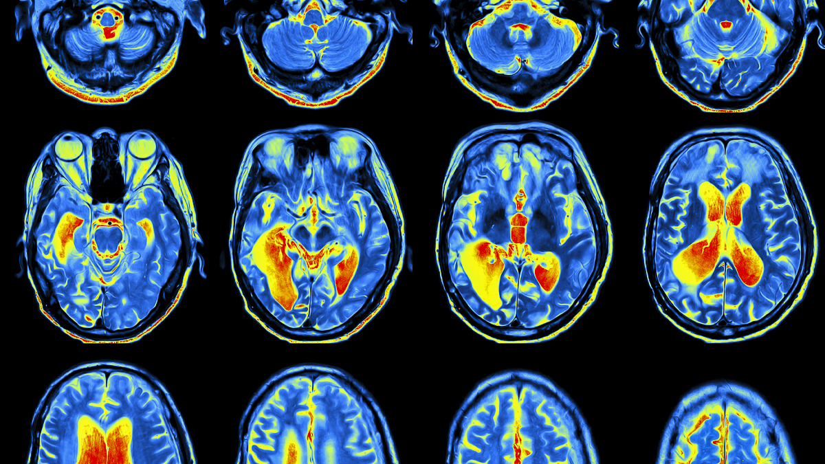 MRI scan results